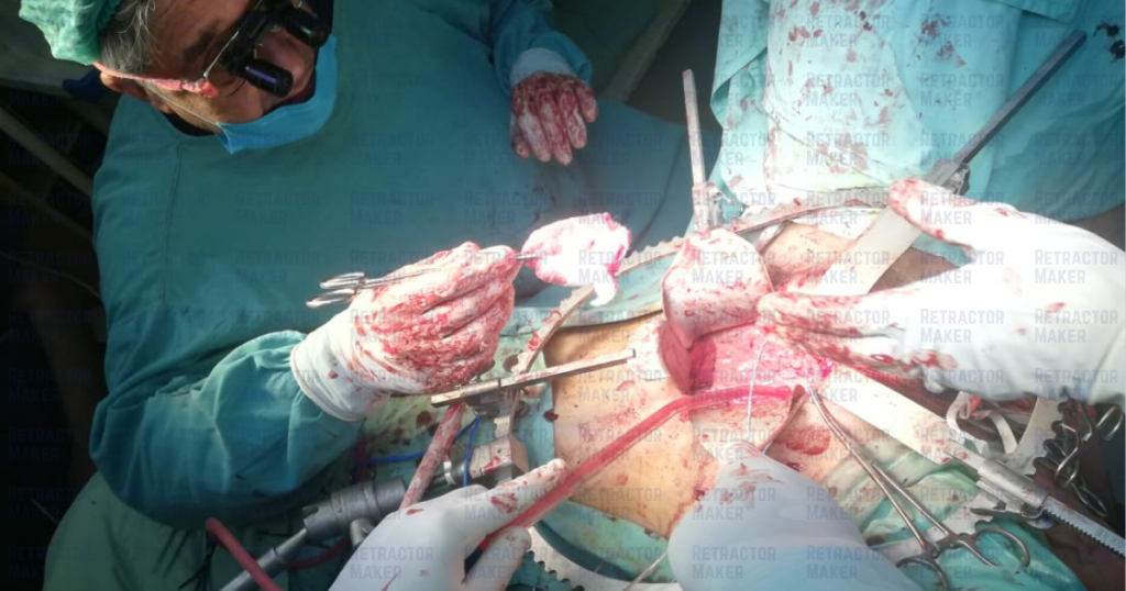 Bookwalter Retractor In Operating Room