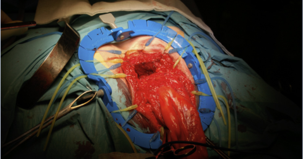 Lone Star Retractor during surgery