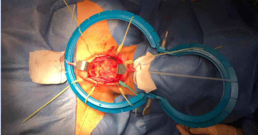 Lone Star Retractor during Gynecology/Male Urology surgery