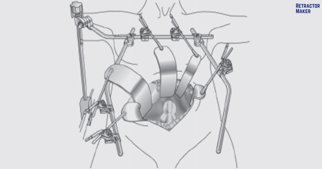 Thompson Retractor Setup