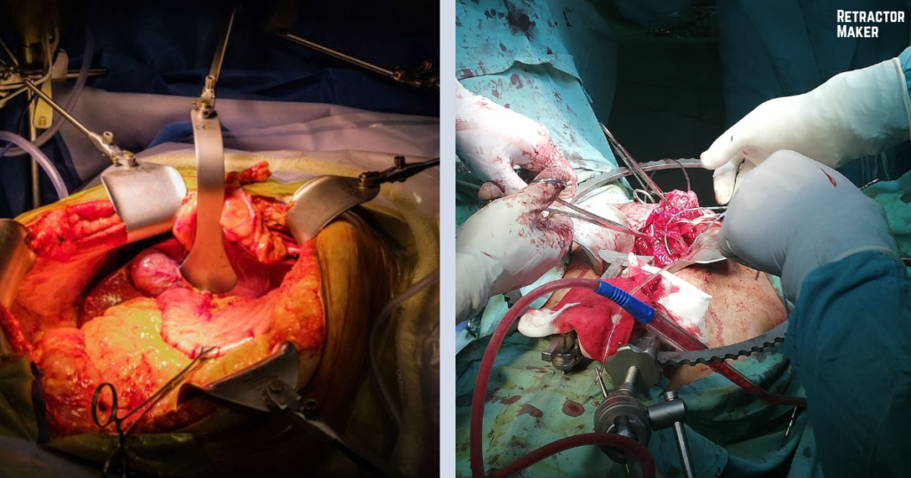 Thompson Retractor vs Bookwalter Retractor: Differences, Features & Which One to Choose