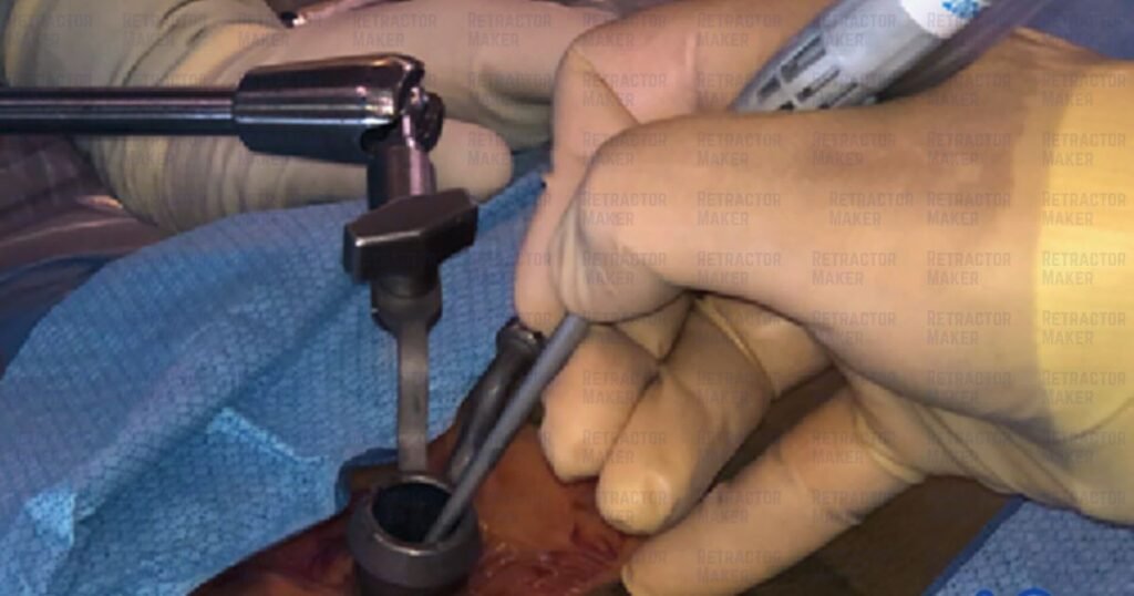 Understanding the Tubular Retractor in Minimally Invasive Surgery
