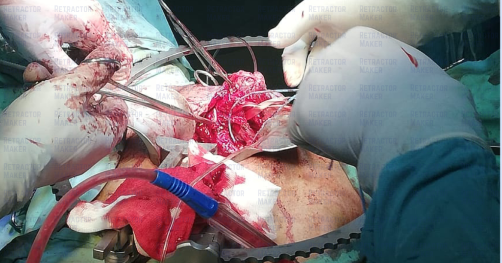 How Surgeons Use Bookwalter Retractor