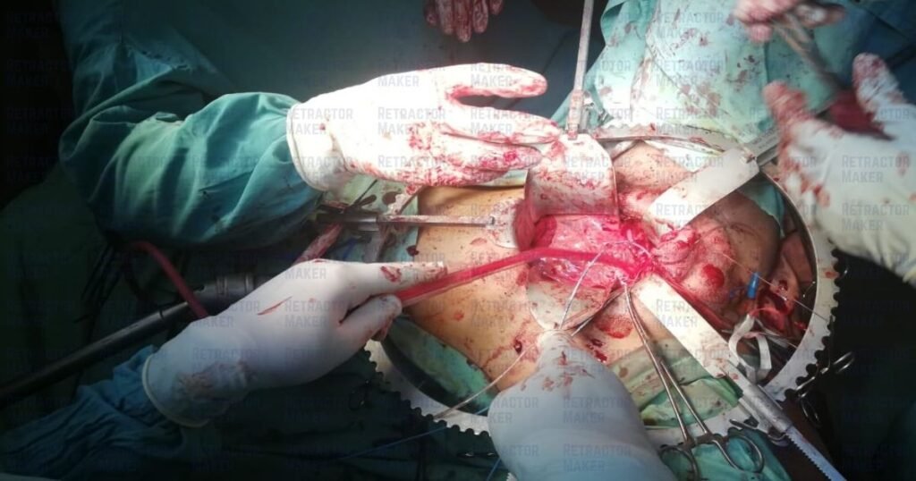 Bookwalter Retractor During Surgery
