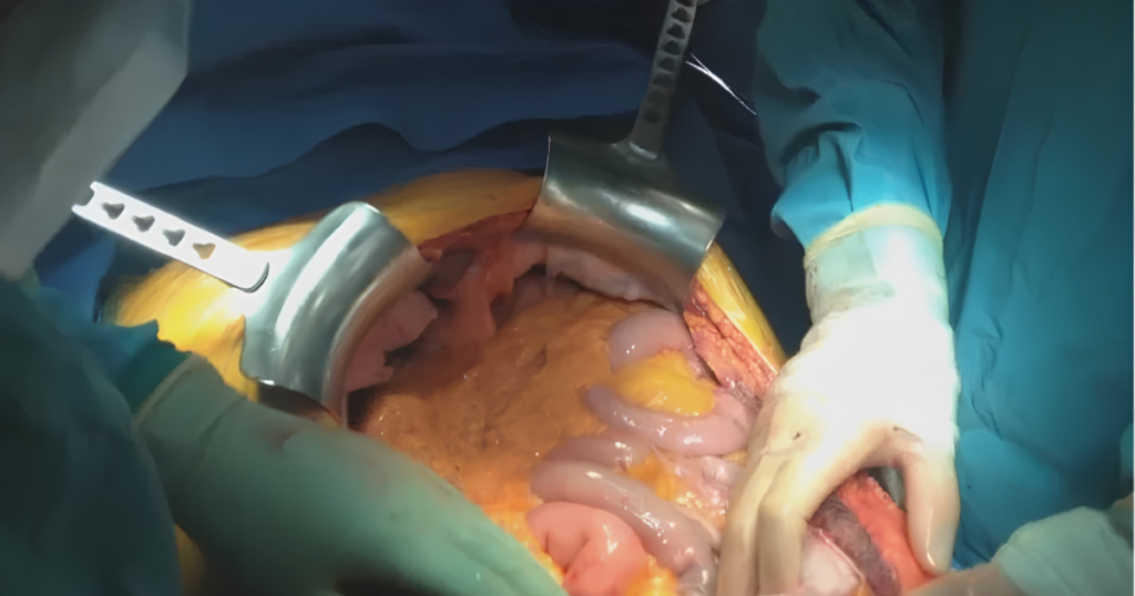 Rochard Retractor During Surgery