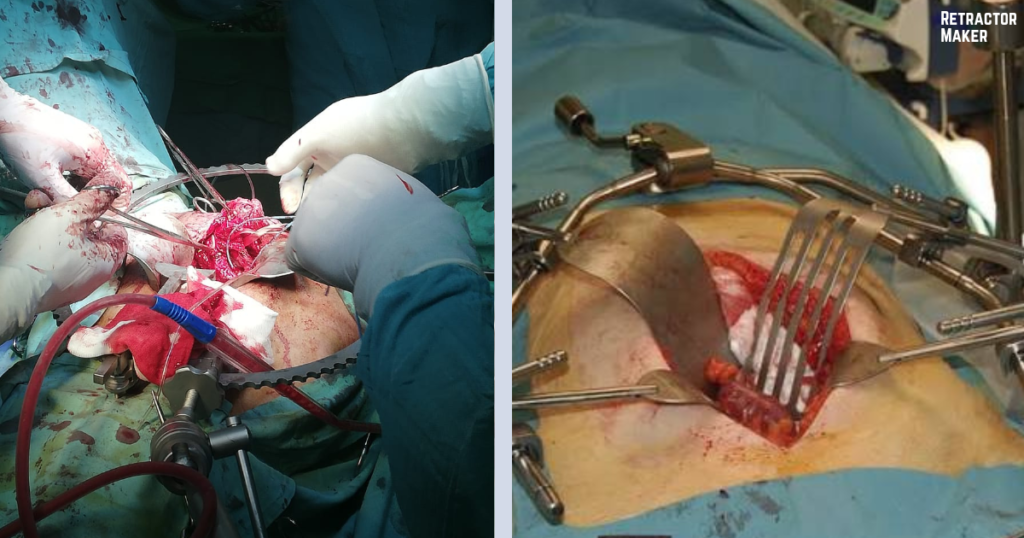 Bookwalter vs Omni Retractor: Key Differences, Features & Which One to Choose
